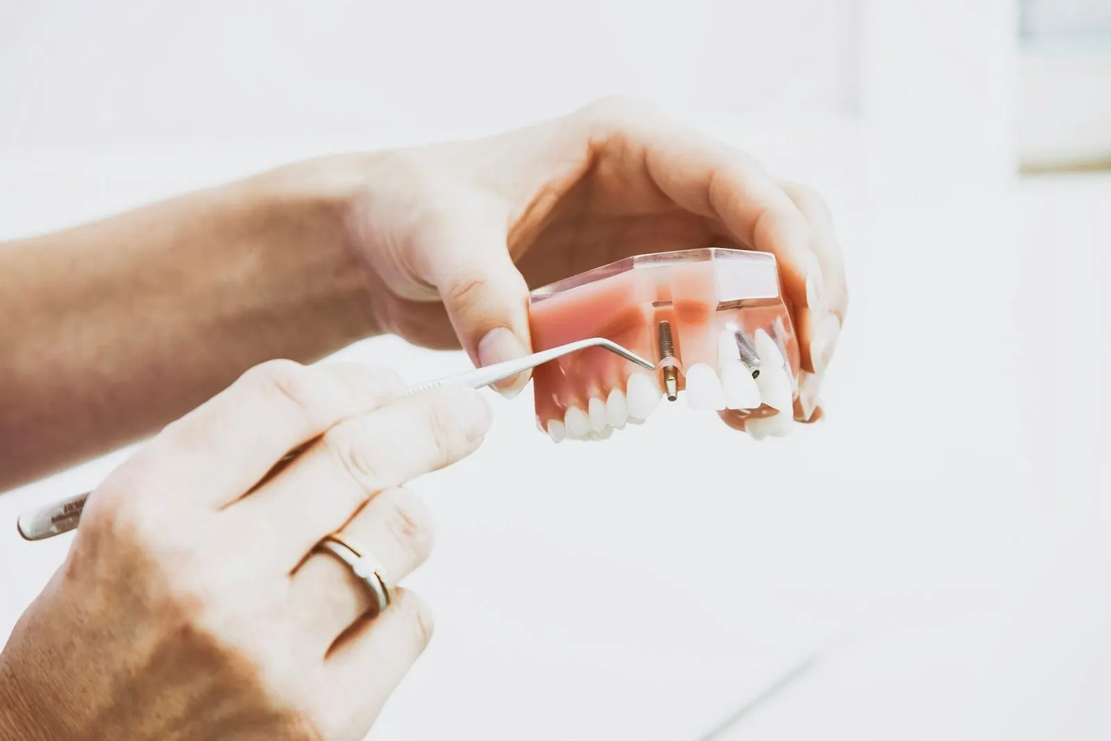 Manos señalando un implante en un modelo dental